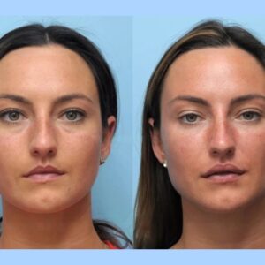 Enhance Your Facial Definition with Thread Lift Treatment in Dubai