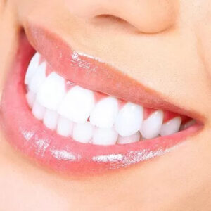 Laser Teeth Whitening in Islamabad