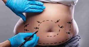 Tummy Tuck in Islamabad