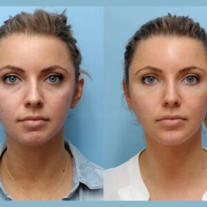 Smooth Wrinkles and Fine Lines Instantly Using Thread Lift Treatment in Dubai