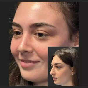 Septoplasty in Dubai