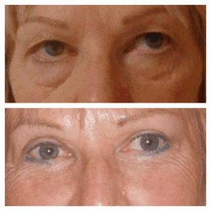 Eye Bag Removal in Dubai