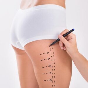 Liposuction in Dubai