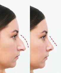 Rhinoplasty in Riyadh